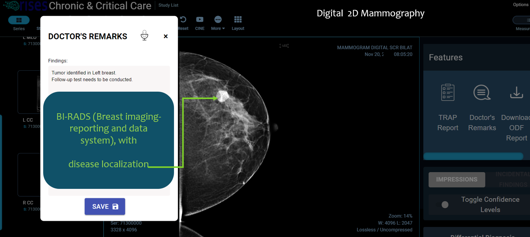 Rises mammogram with BI-RADS overlay