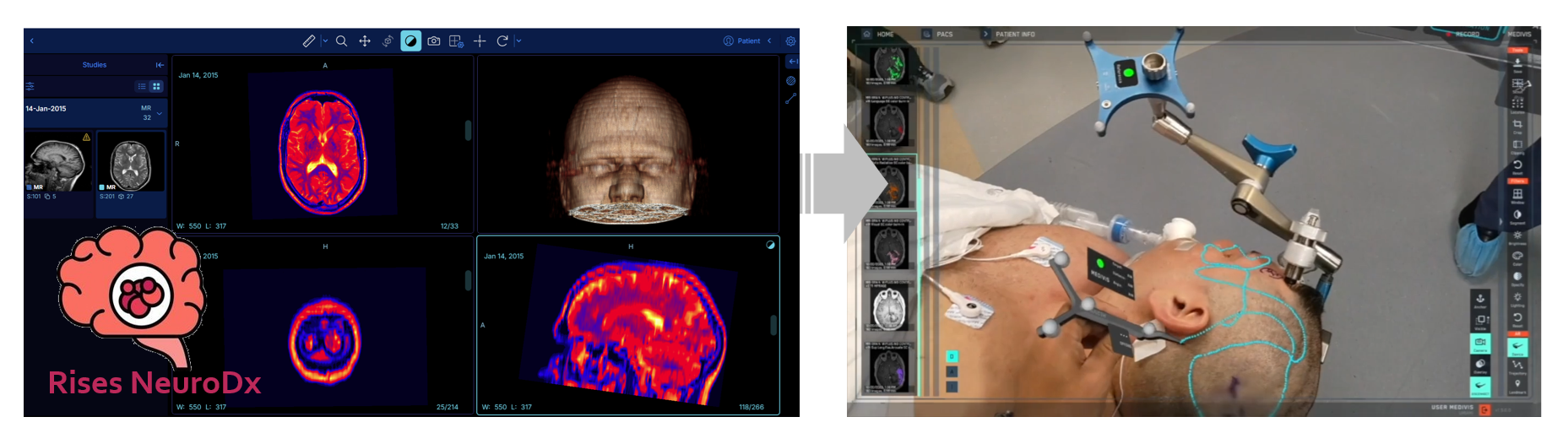 Rises NeuroDx and Onco solutions